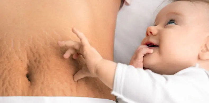 איך מתמודדים עם סימני מתיחה - מה קורה לגוף האישה לאחר לידה